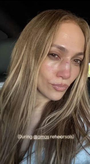 Jennifer Lopez, Amerikan Müzik Ödülleri provaları sırasında yüzünden yaralandı